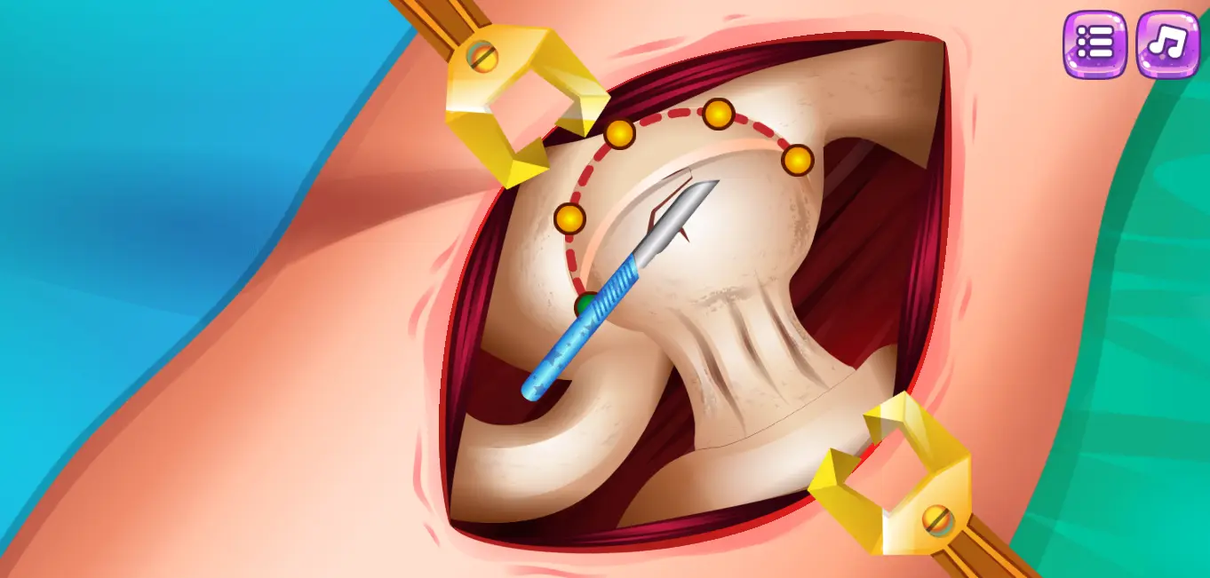 Princess Hips Surgery