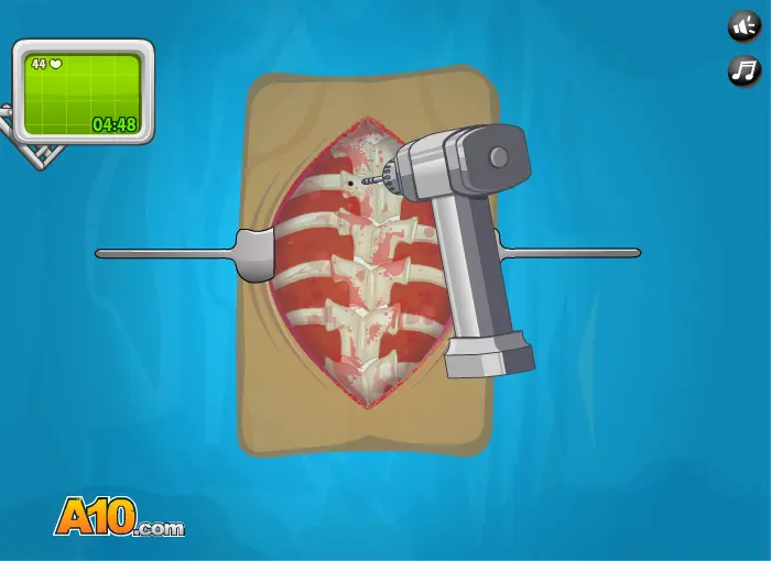 Operate Now! Scoliosis Surgery