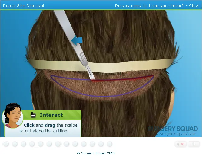 Surgery Squad: Virtual Hair Transplant